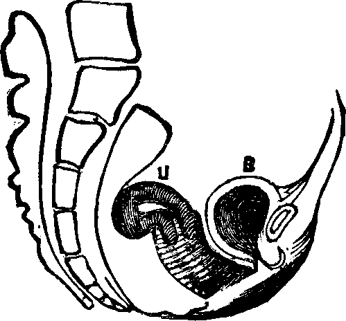 Illustration: Fig. 12. Retroflexion, U, Uterus (Womb), B, Bladder.