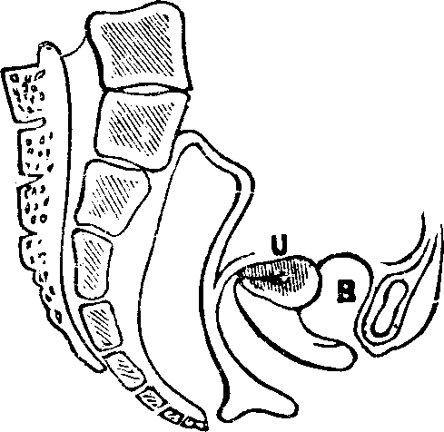 Illustration: Fig. 14. Anteversion, U, Uterus, B, Bladder.