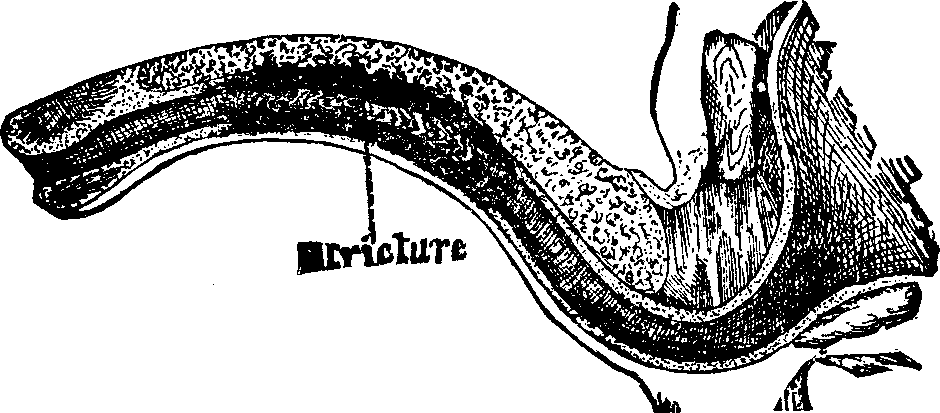 Illustration: Fig. 4. Condition of the urethra in Case 112,289; permanently cured at the Invalids' Hotel and Surgical Institute.