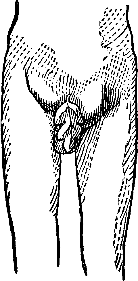 Illustration: Fig. 1. Indirect Inguinal Hernia.