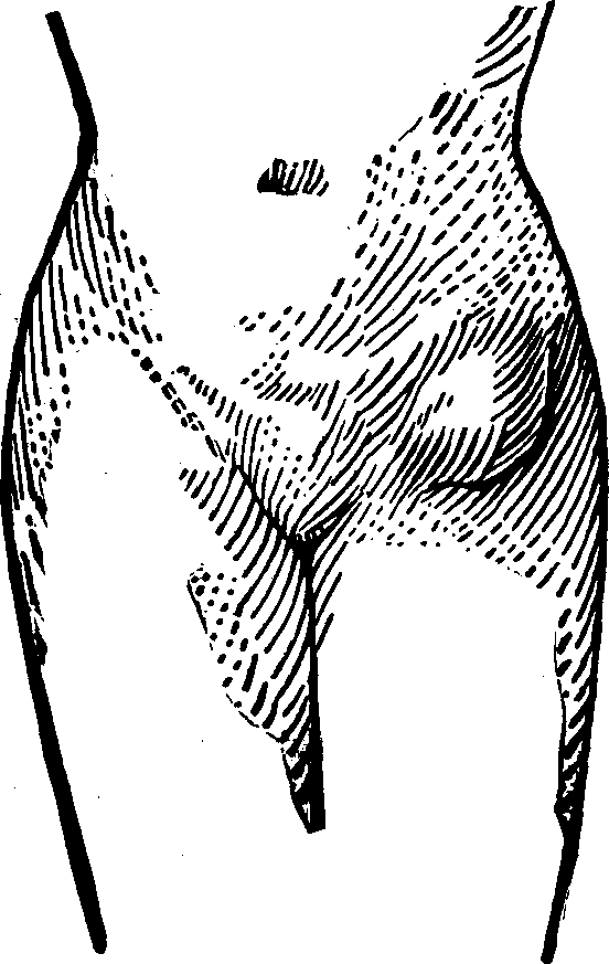 Illustration: Fig. 2.  This figure illustrates a case of Femoral Hernia 