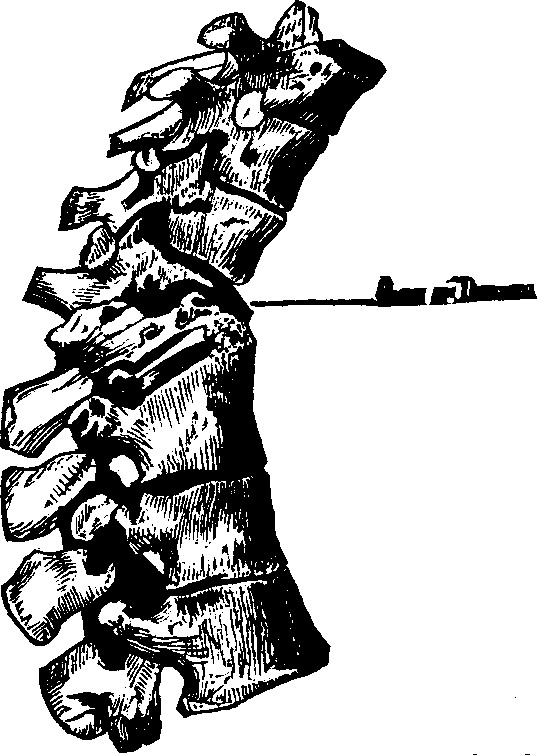 Illustration: Fig. 1.  The above portion of the spinal column shows the manner of the breaking down of the vertebræ from caries, and the absorption of their bony structure.