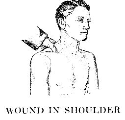 WOUND IN SHOULDER