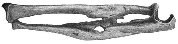 Fig. 7.—Excessive Callus Formation after infected Compound Fracture of both Bones of Forearm—result of gun-shot wound. Fusion of Bones across Interosseous Space.