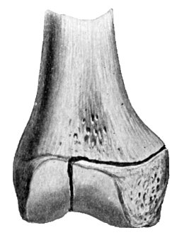 Fig. 10.—Partial Separation with Fracture of Epiphysis.