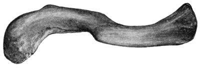 Fig. 13.—Oblique Fracture of Right Clavicle in Middle Third, united.