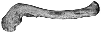 Fig. 14.—Fracture of Acromial End of Clavicle. Shows forward rotation of lateral fragment, and line of fracture united by bone.