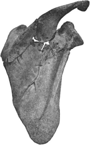 Fig. 26.—Transverse Fracture of Scapula, with fissures radiating into spinous process and dorsum.