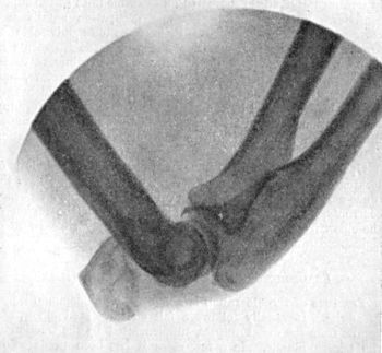 Fig. 35.—Radiogram of Fracture of Olecranon Process, showing marked degree of displacement.