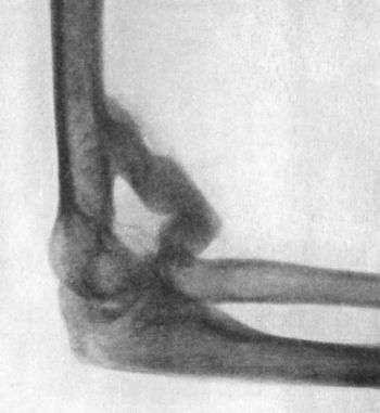 Fig. 37.—Bony Outgrowth in relation to insertion of Brachialis Muscle, following Backward Dislocation of Elbow.