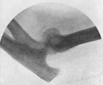 Fig. 38.—Radiogram of Incomplete Backward Dislocation of Elbow.