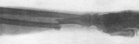 Fig. 46.—Radiogram of Chauffeur's Fracture.