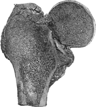 Fig. 61.—Fracture through Narrow Part of Neck of Femur on section. The Neck of the bone has undergone absorption.