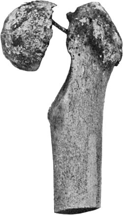 Fig. 64.—Fracture of Narrow Part of Neck of Femur. The neck has become absorbed, the head has not united, and a false joint has formed.