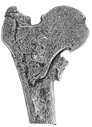 Fig. 67.—Fracture through Base of Neck of Femur with Impaction into the Trochanters.