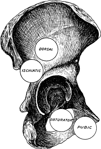 Fig. 71.—Diagram of the most common Dislocations of the Hip.