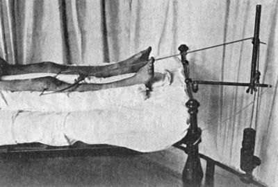 Fig. 76.—Radiogram of Steinmann's Apparatus applied for Direct Extension to the Femur.