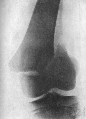 Fig. 83.—Separation of Lower Epiphysis of Femur, with fracture of lower end of diaphysis.