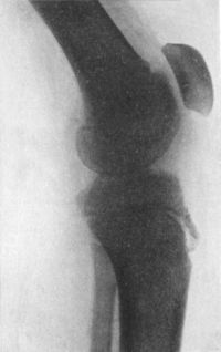 Fig. 85.—Radiogram illustrating Schlatter's disease.