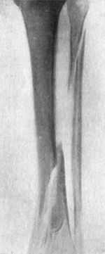 Fig. 90.—Radiogram of Oblique Fracture of both Bones of Leg by indirect violence.