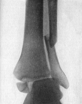 Fig. 94.—Radiogram of Pott's Fracture with lateral displacement of foot.