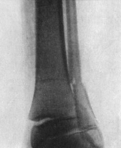 Fig. 98.—Radiogram of Fracture of lower end of Fibula, with separation of lower epiphysis of Tibia.