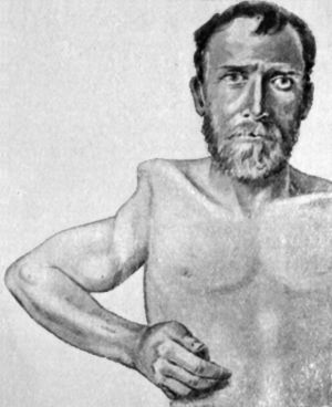 Fig. 103.—Arthropathy of Shoulder in Syringomyelia. The upper end of the humerus has disappeared and the movements are flail-like (cf. Fig. 104).