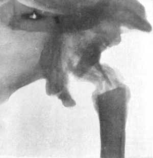 Fig. 104.—Radiogram of specimen of Arthropathy of Shoulder in Syringomyelia. The head of the humerus has disappeared and masses of new bone have formed in the surrounding muscles (cf. Fig. 103).