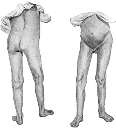 Fig. 109.—Early Tuberculous Disease of Right Hip-joint in a boy æt. 14, showing flexion, abduction, and apparent lengthening of the limb.