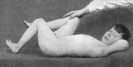 Fig. 113.—Thomas' Flexion Test, showing angle of flexion at diseased (left) hip.