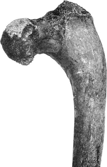 Fig. 120.—Upper End of Femur in advanced Arthritis Deformans of Hip. The shaft is curved and the head of the bone is at a lower level than the great trochanter.