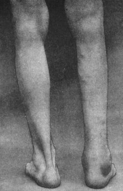 Fig. 126.—Tuberculous Disease in a man æt. 35, of six weeks' duration.