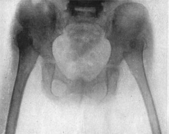 Fig. 128.—Radiogram of Double Congenital Dislocation of Hip in a girl æt. 4.