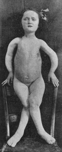 Fig. 137.—Female child with Rickety deformities of upper and lower extremities.