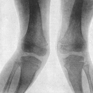 Fig. 138.—Radiogram of case of Double Genu Valgum in a child æt. 4.