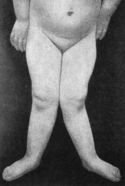 Fig. 139.—Genu Valgum in a child æt. 4. Patient standing.