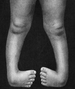 Fig. 142.—Bilateral Congenital Club-foot in an infant.