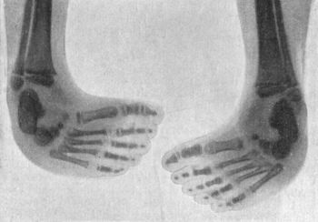 Fig. 143.—Radiogram of Bilateral Congenital Club-foot in an infant.