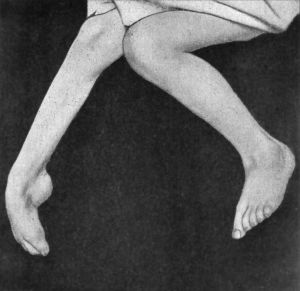 Fig. 146.—Extreme form of Pes Equinus in a girl æt. 8, the result of Anterior Poliomyelitis.