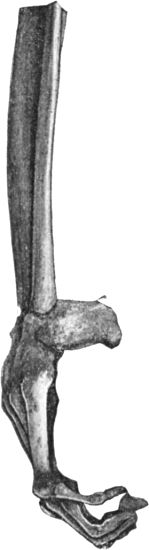 Fig. 147.—Skeleton of Foot from case of Pes Equinus due to Poliomyelitis.