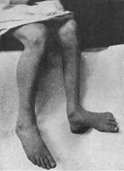 Fig. 149.—Pes Calcaneo-valgus, the result of Poliomyelitis.