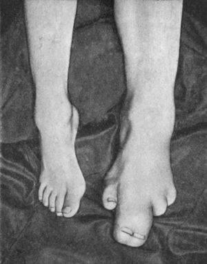 Fig. 162.—Congenital Hypertrophy of Left Lower Extremity in a boy æt. 5. The second and third toes are fused.