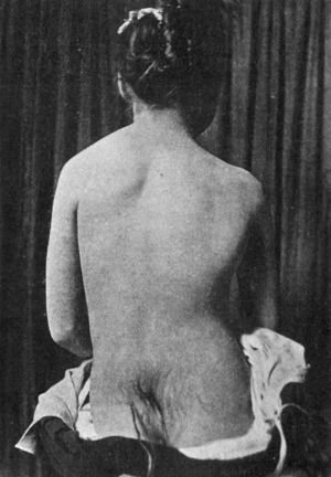 Fig. 164.—Congenital elevation of Left Scapula in a girl: also shows hairy mole over Sacrum.