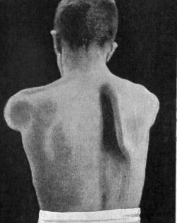 Fig. 165.—Winged Scapula; the patient is holding the arms out in front.