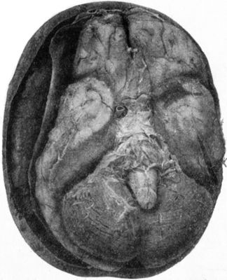 Fig. 187.—Extra-Dural Clot resulting from hæmorrhage from the Middle Meningeal Artery.