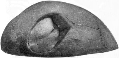 Fig. 189.—Depressed and Comminuted Fracture of Right Parietal Bone: Pond Fracture. The patient sustained the injury twenty years before death.