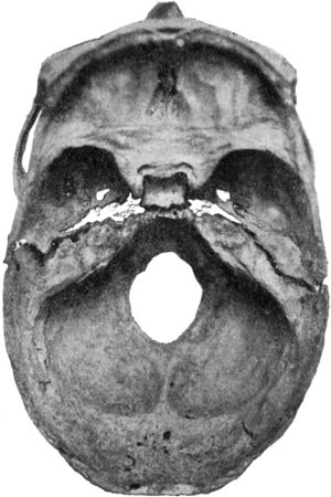 Fig. 191.—Transverse Fracture through Middle Fossa of Base of Skull.