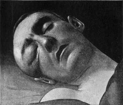 Fig. 193.—Pott's Puffy Tumour in case of extra-dural abscess following compound fracture of orbital margin; infected with road-dust; operation; recovery. At the time of the photograph the man was unconscious.