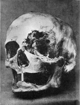 Fig. 204.—Destruction of Bones of Left Orbit, caused by Rodent Cancer. The patient died of septic meningitis.