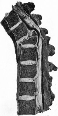 Fig. 208.—Fracture—Dislocation of Ninth Thoracic Vertebra, showing downward and forward displacement of upper segment, and compression of cord by upper edge of lower segment.